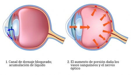 Causas del glaucoma
