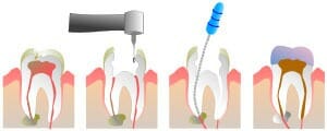 Procedimiento de una endodoncia