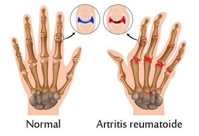 Causas de la artritis