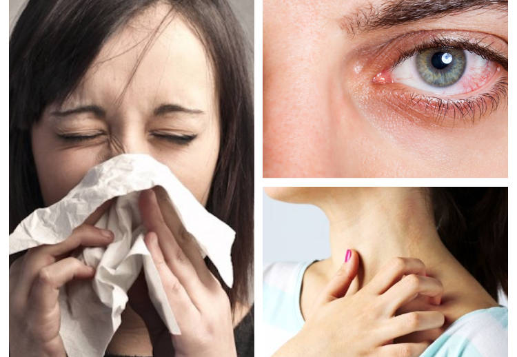 Síntomas de la alergia al polen