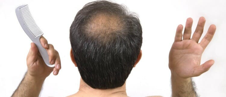 Síntomas de la alopecia
