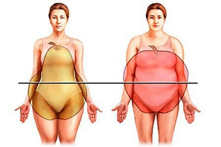 Tipos de obesidad