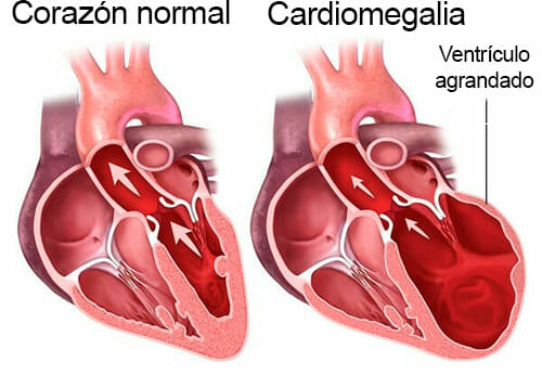 Causas de la cardiomegalia