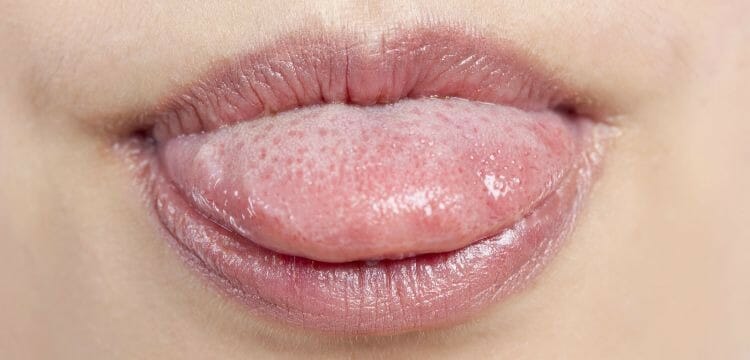 Remedios caseros para las llagas en la lengua