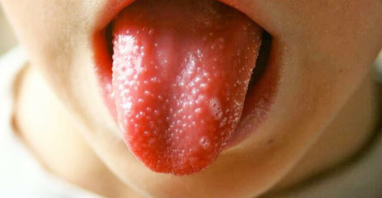 Granos en la lengua en niños