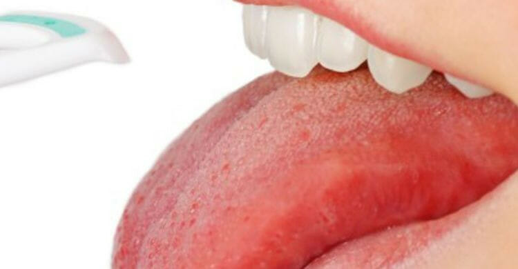舌黄の治療