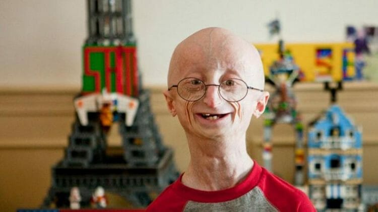 Enfermedad rara progeria de Hutchinson-Gilford