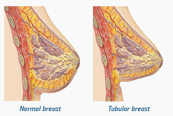 Causas de las mamas tubulares