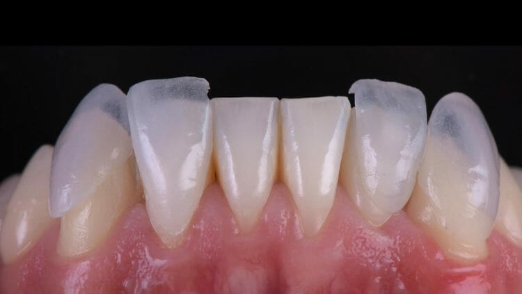 Micro carillas dentales