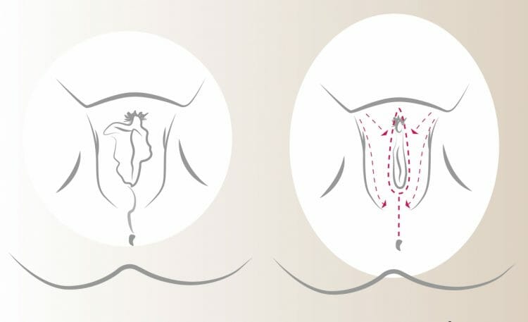 Recomendación de vaginoplastia