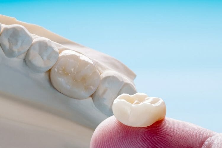 Recomendaciones corona dental