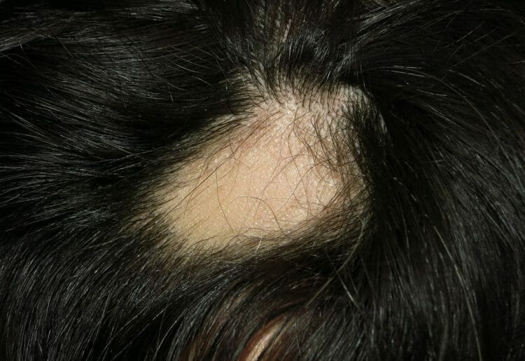 Síntomas de la alopecia areata