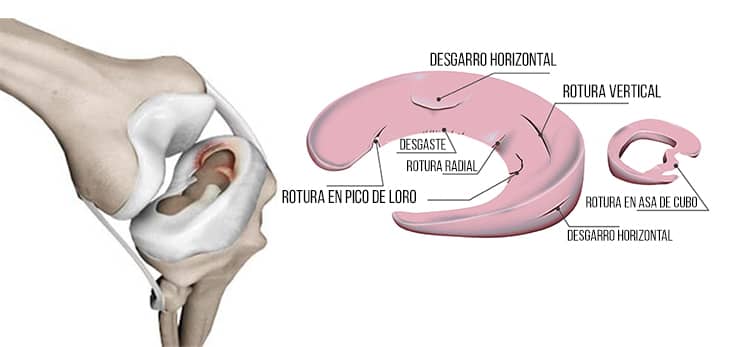 Rotura de menisco interno