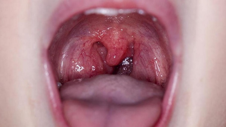 Uvulitis