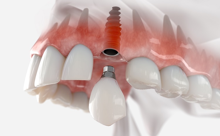 Qué tipos de implantes dentales hay Cuáles son los más adecuados para mi