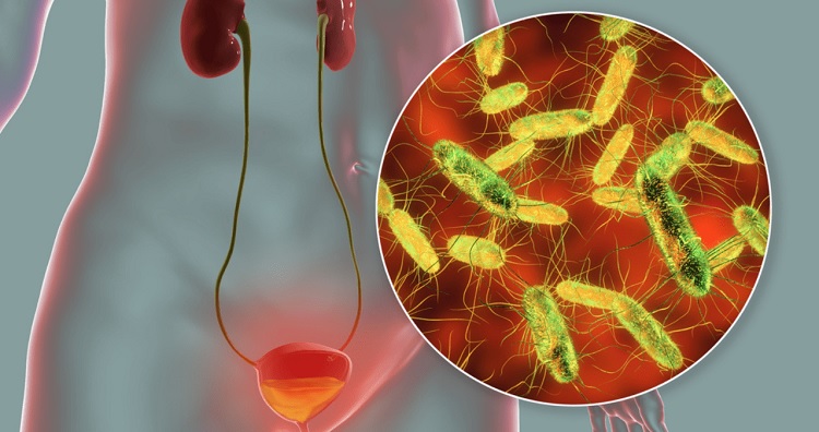 Infección de orina por escherichia coli causas y cómo tratarla