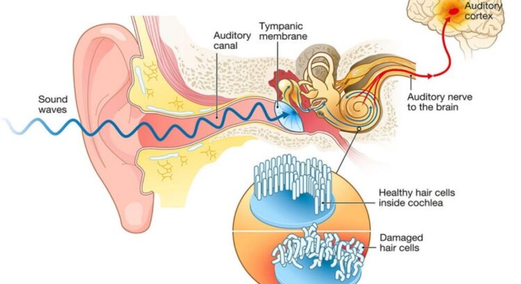 Problemas auditivos Tinnitus