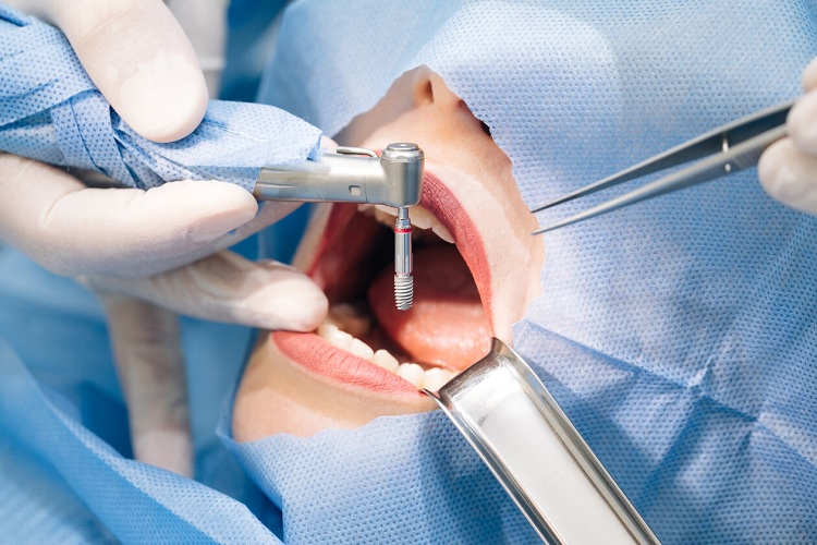 Colocar implantes dentales