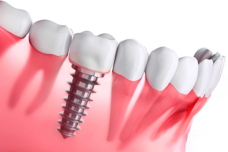 Implantes dentales qué son y para qué sirven